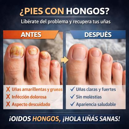 NailCure™ – Láser Antihongos Profesional para Uñas + ¡ENVÍO GRATIS! 🔥